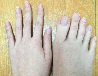 女子做足疗，脱鞋后技师惊呼从业十年首见